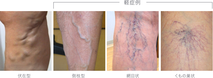 ■見た目でわかる、4タイプの下肢静脈瘤